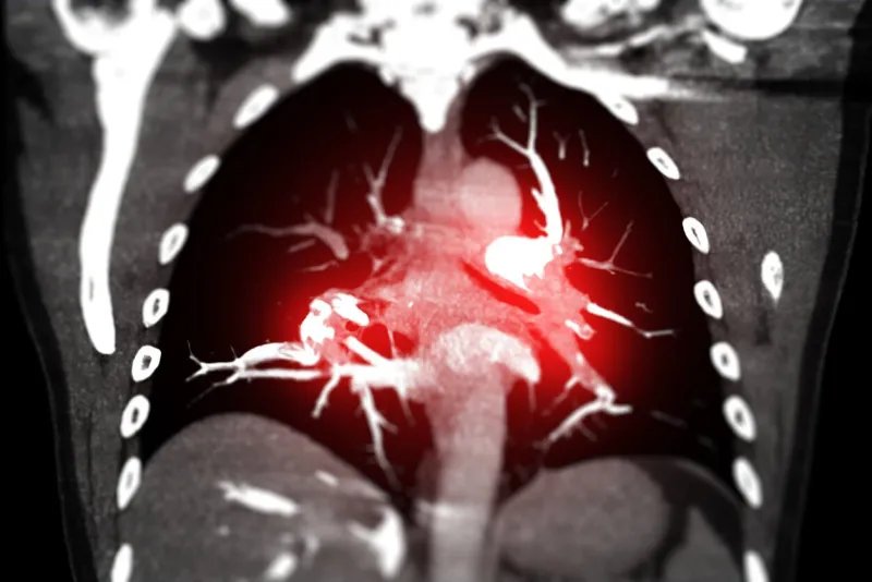 cta chest or ctpa with contrast media coronal view showing pulmonary embolism (pe)