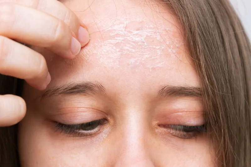 close-up of a female forehead with peeling skin isolated on a white background allergies, eczema, psoriasis, lack of vitamins, erythema, itching