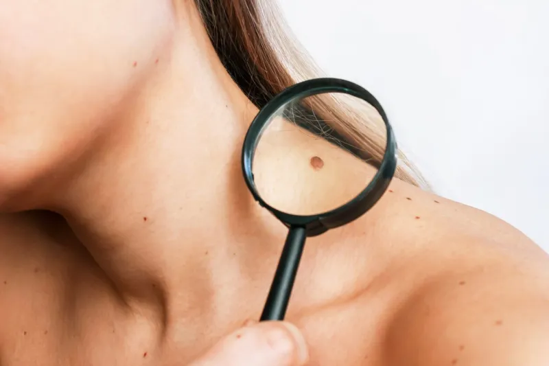 close-up of a big mole on a young woman's neck magnified with a magnifying glass isolated on a gray background the effect of sunlight on the skin
