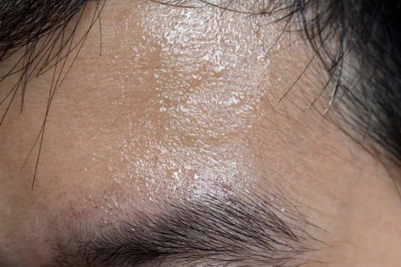 excessive sweating or hyperhidrosis and oily skin at forehead of southeast asian, myanmar or chinese adult young man oily skin is the result of overproduction of sebum from sebaceous glands