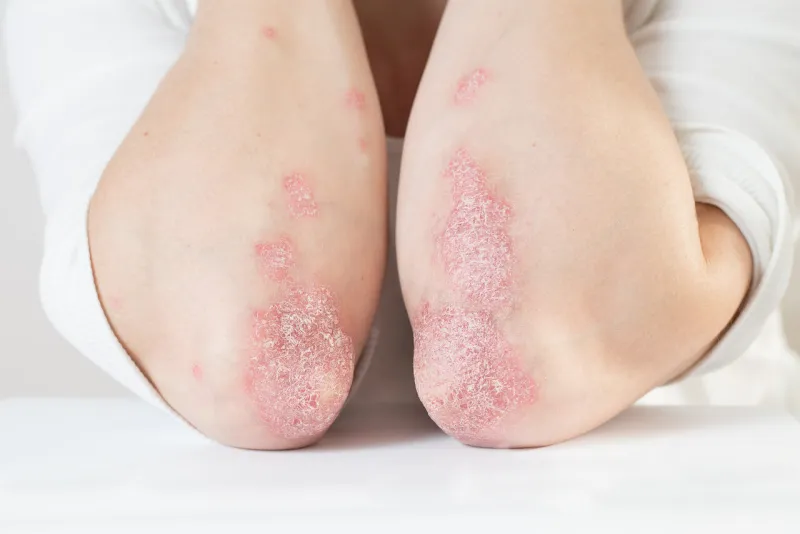 acute psoriasis on the elbows is an autoimmune incurable dermatological skin disease large red, inflamed, flaky rash on the knees joints affected by psoriatic arthritis