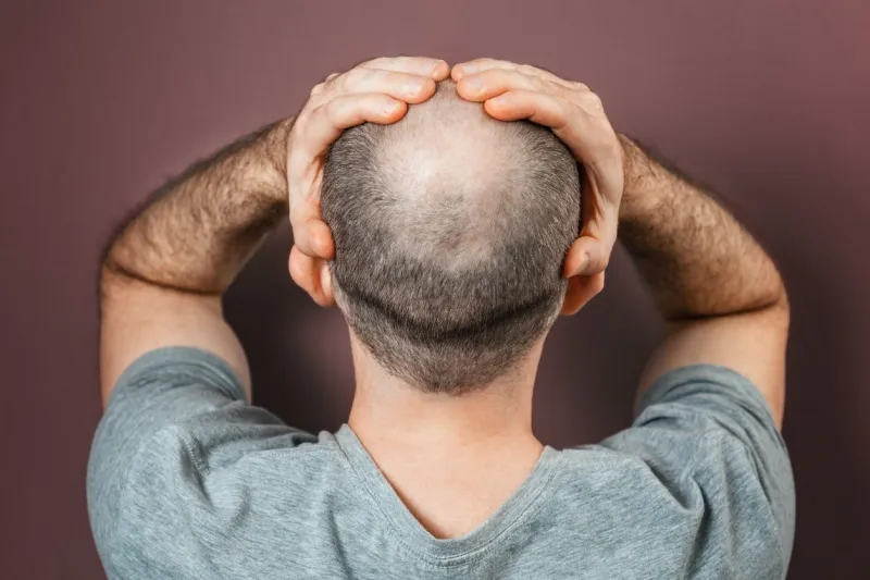 self-doubt and inferiority complex baldy adult man grabs his head with his hands rear view brown background the concept of alopecia and baldness
