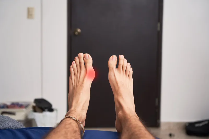 feet of person with bunion, medical condition of deformation of the bones