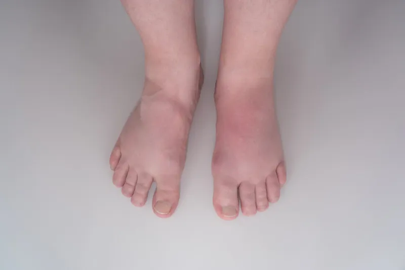 rot geschwollener fuß