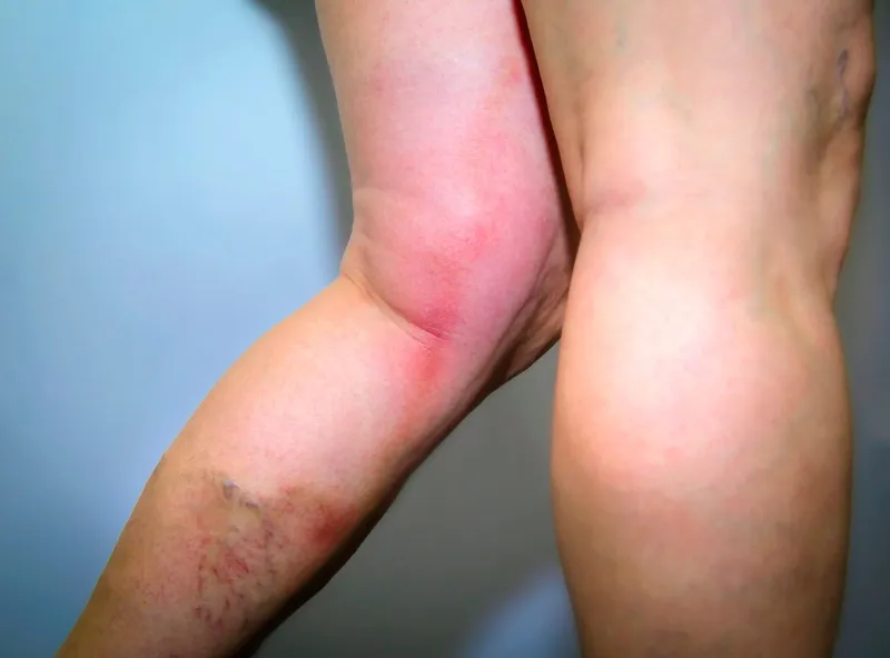 thrombophlebitis in human leg painful inflamation of the leg veins medical issue