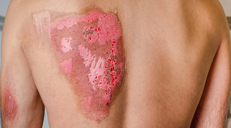 second-degree burns on male back caused by heat medical concept