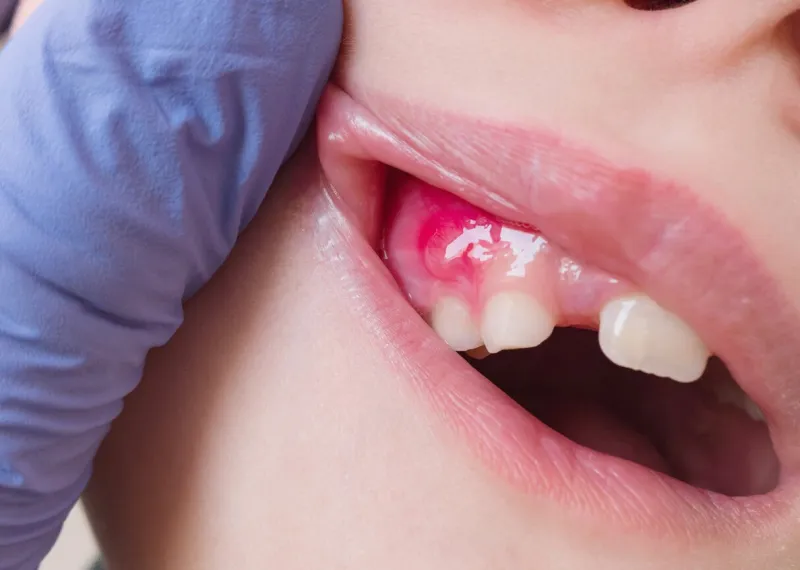 painful pus-filled swelling abscess in the gum of the mouth in a 8 year old child