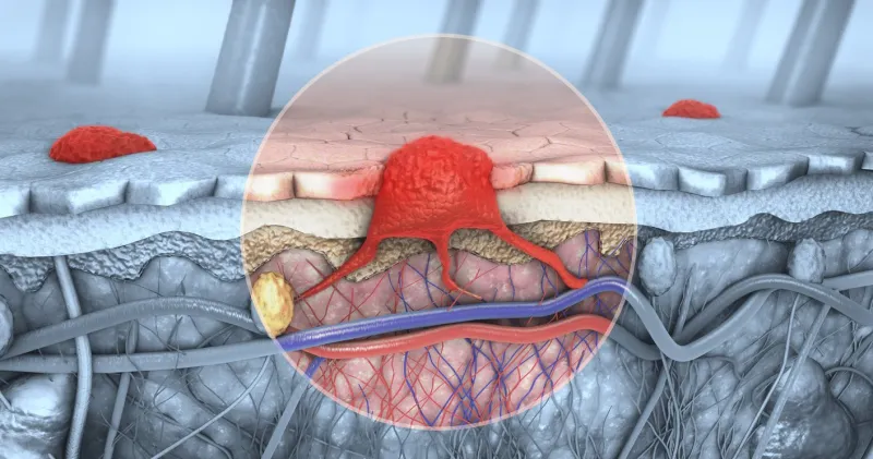 3d illustration of a cross-section of a diseased skin with melanoma that enters the bloodstream and lymphatic tract