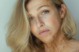 Julie, brûlée à 40 % 