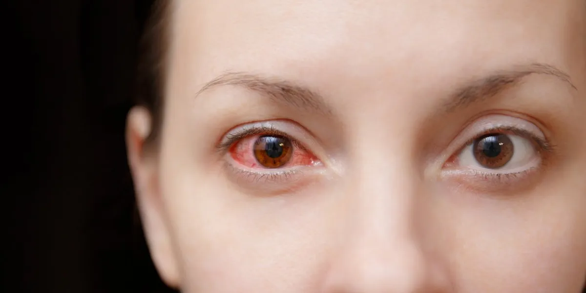 close up of one annoyed red blood and health eye of female affected by conjunctivitis or after flu, cold or allergy concept of disease and treatment copy space for advertisement with place for text