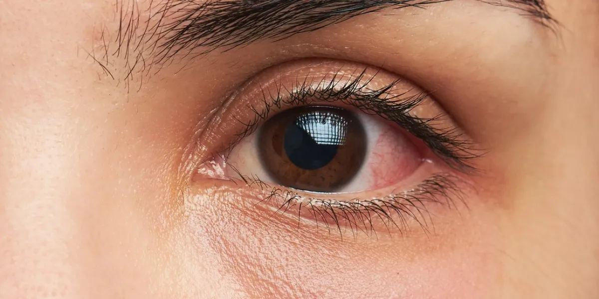 close up macro of one woman eye with infection