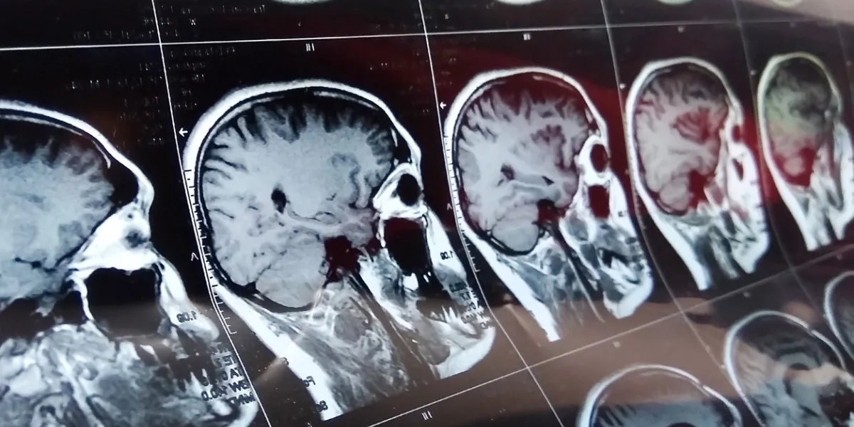 magnetic resonance scan of the brain with skull mri head scan on dark background blue color x-ray medicine and medication concept