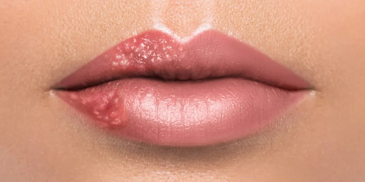 close up of female lips affected by herpes virus