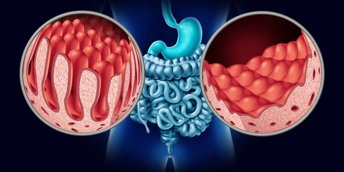 celiac or coeliac disease as an intestine anatomy medical concept with normal villi and damaged small bowel lining as an autoimmune disorder of the digestion system with colon and stomach as a 3d illustration