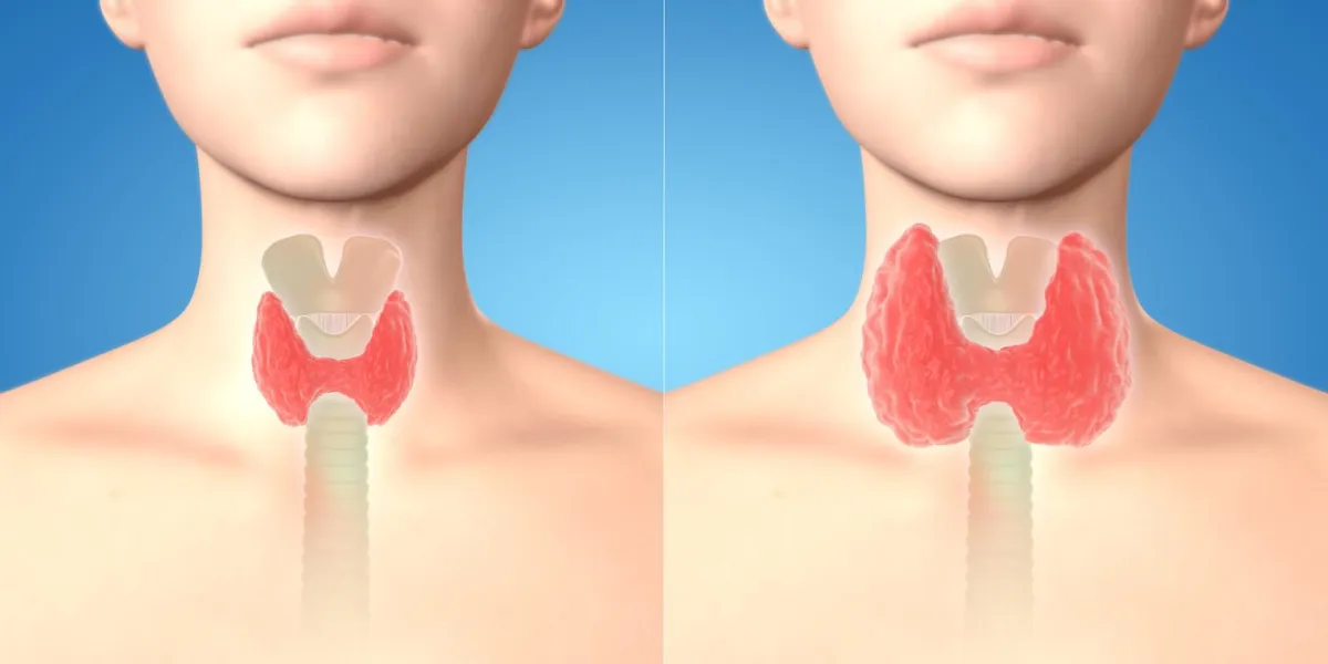 3d render of normal thyroid glands and goiter in the human female body