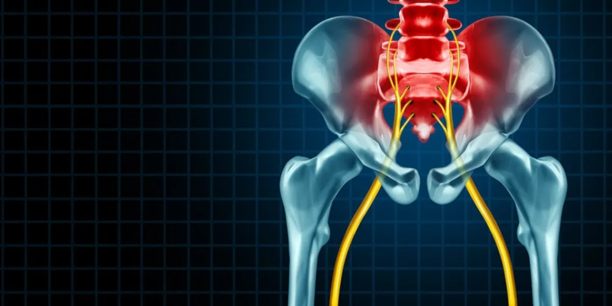 painful sciatica nerve symptom and pain diagnosis as a medical concept for a disease causing physical problems with 3d illustration elements
