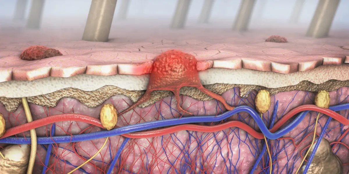 3d illustration of a cross-section of a diseased skin with melanoma that enters the bloodstream and lymphatic tract
