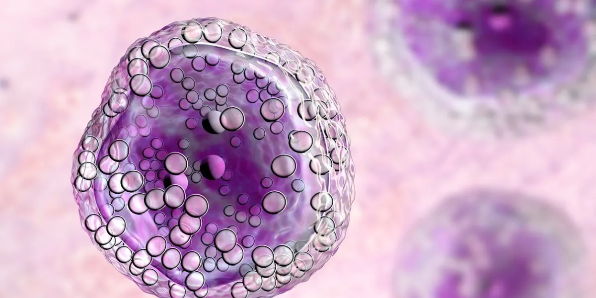 burkitt's lymphoma cells, is a cancer of the lymphatic system, a monoclonal b-cell tumor, 3d illustration