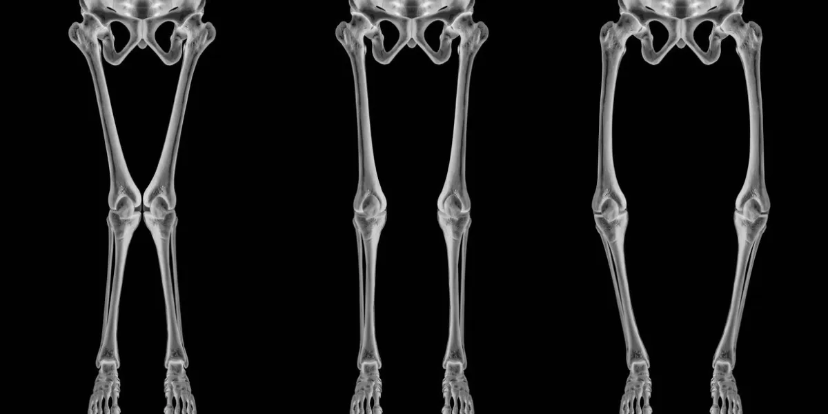 x-ray of types disease leg bone problem of knock knee -normal and bowlegs or valgus and varus knee- 3d medical illustration- human anatomy and medical concept-isolated on black background