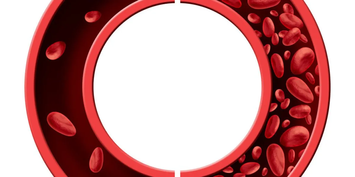 anemia and anaemia medical diagram concept as normal and abnormal blood cell count and human circulation in an artery or vein as a 3d illustration isolated on a white background