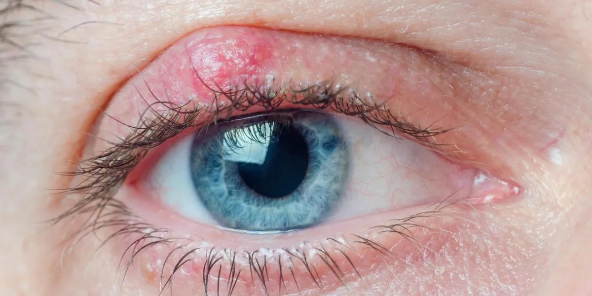 chalazion on the eyelid of a man close-up