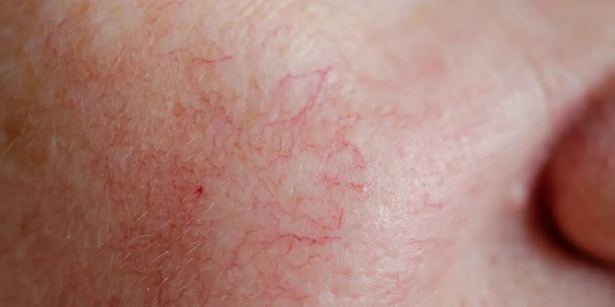 close up of human face skin with vascular problems, couperose on sensitive skin
