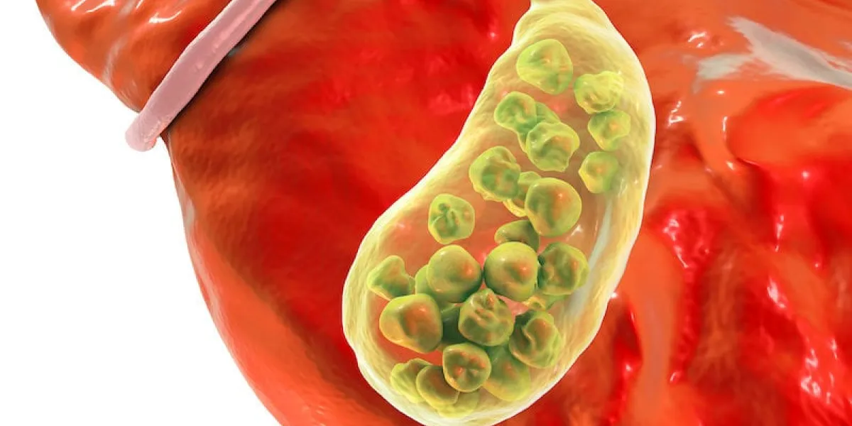 gallstones, 3d illustration showing bottom view of liver and gallbladder with stones