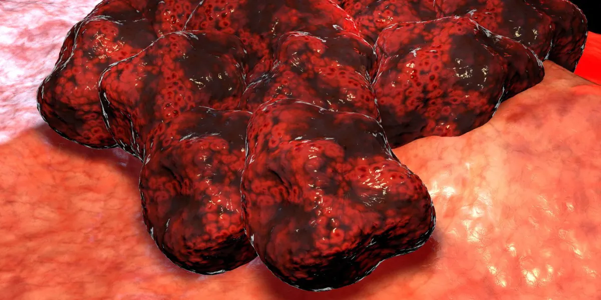 cancer cell tumor, medical illustration neoplasm inflammation caused by an abnormal growth of tissue, whether benign or malignant