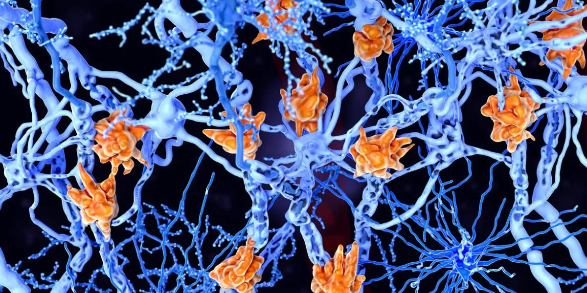 multiple sclerosis (ms)  microglia cells damage the myelin sheath of neuron axons