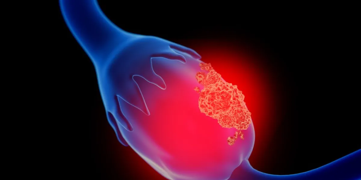 3d illustration of ovarian cancer