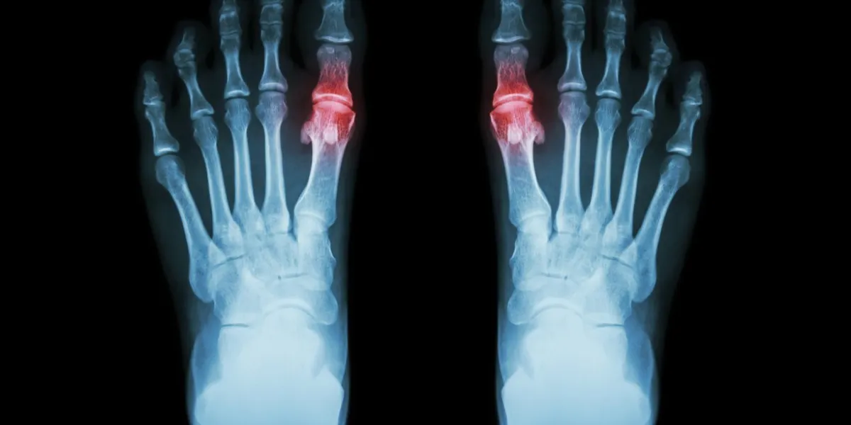 gout , rheumatoid arthritis ( film x-ray both foot and arthritis at first metatarsophalangeal joint ) ( medicine and science background )