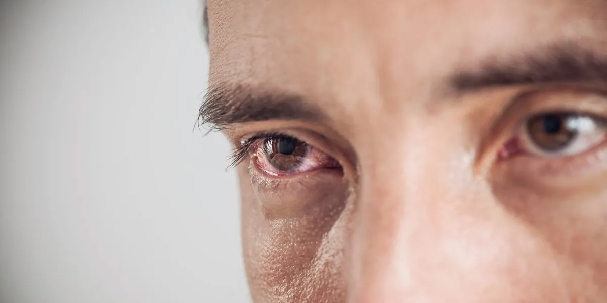 close up of a red eye