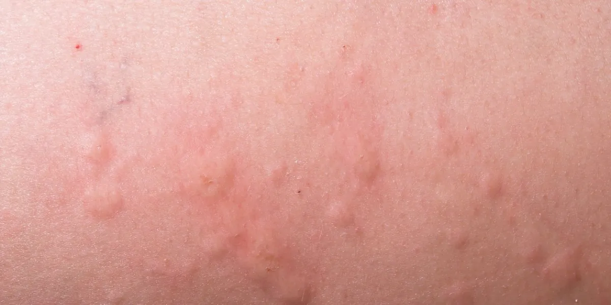 an allergic reaction causeing a severe case of hives