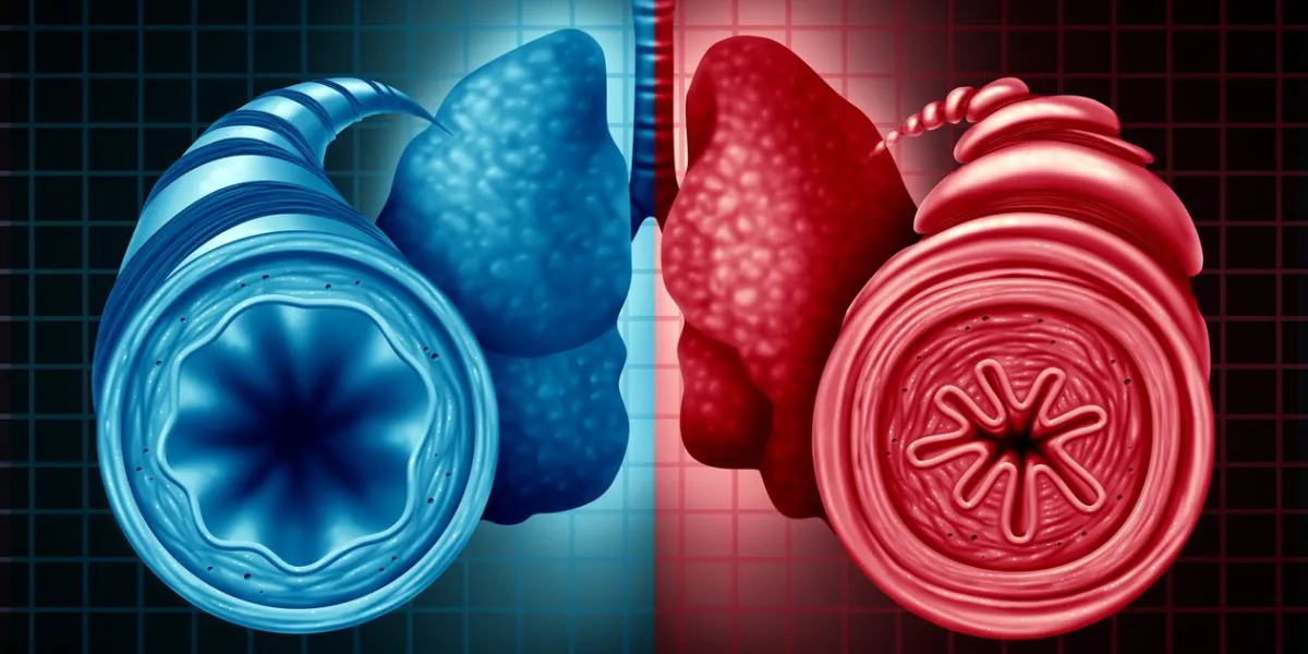 asthma health diagnosis as a diagram with a healthy and unhealthy bronchial tube with a constricted breathing problem caused by respiratory muscle tightening with 3d illustration elements