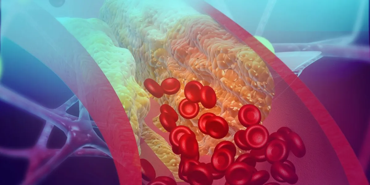 cholesterol blocking artery 3d illustration