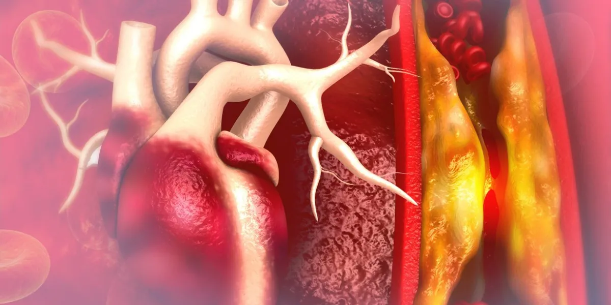cholesterol plaque in artery with human heart anatomy 3d illustration
