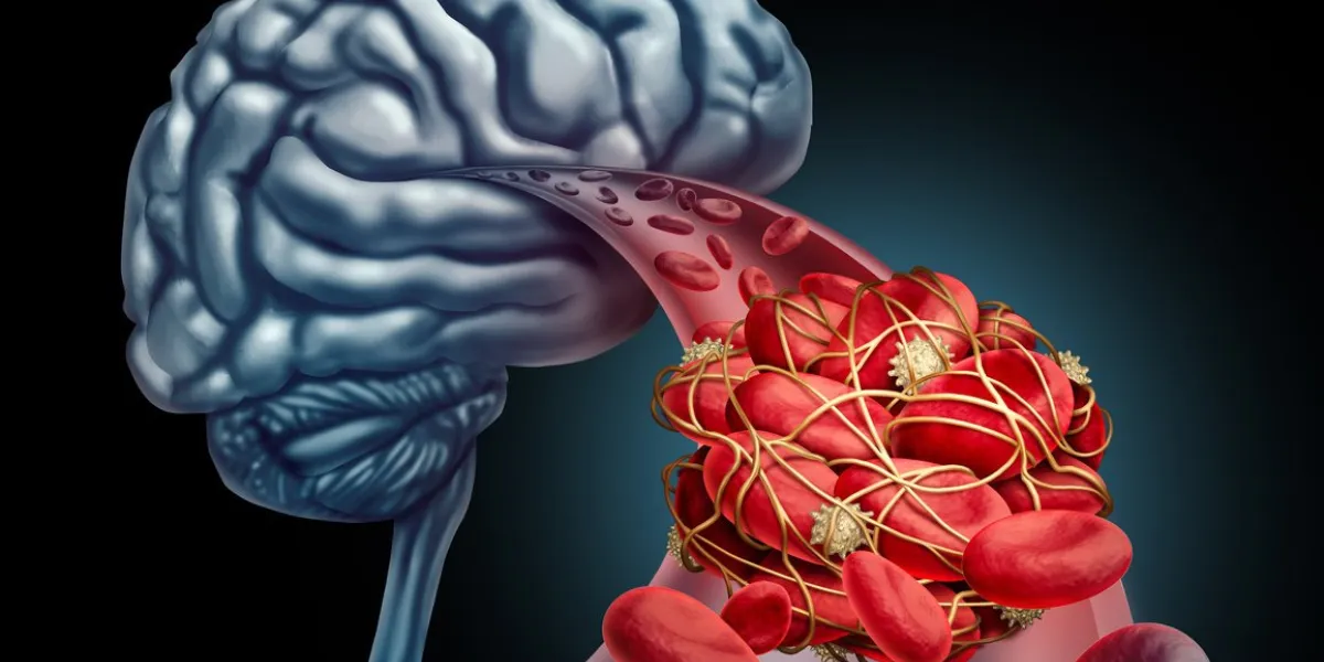 blood clot brain medical concept as 3d illustration blood cells blocked by an artery blockage thrombus causing a blockage of blood flow to the neurology anatomy in a black background