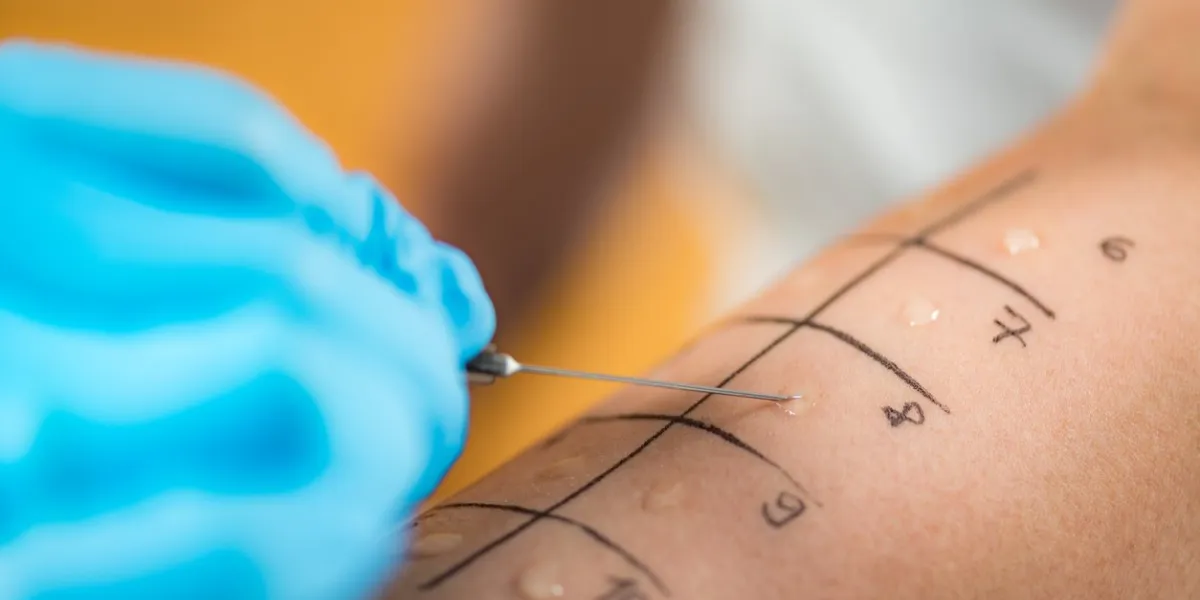 immunologist doing skin prick allergy test on a woman’s arm