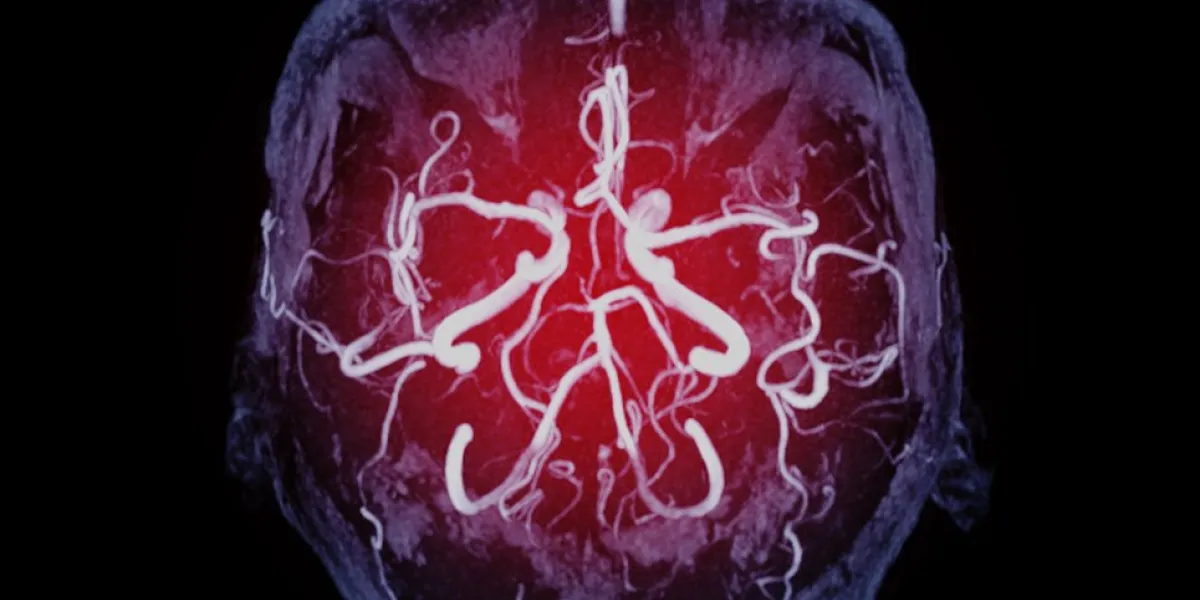 mra brain axial mip view showing vessel in the brain name is circle of willis
