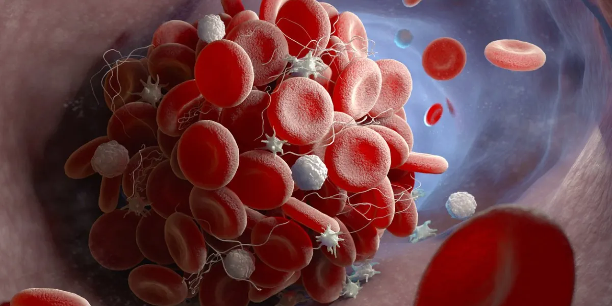 depiction of a blood clot forming inside a blood vessel 3d illustration