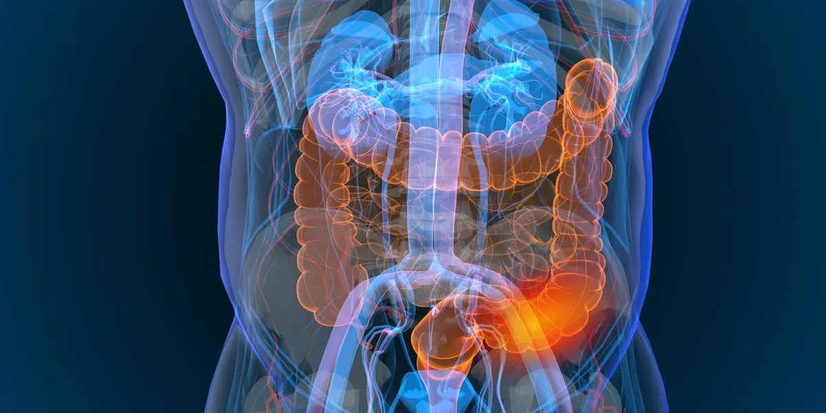 3d rendered illustration of bowel cancer 3d illustration