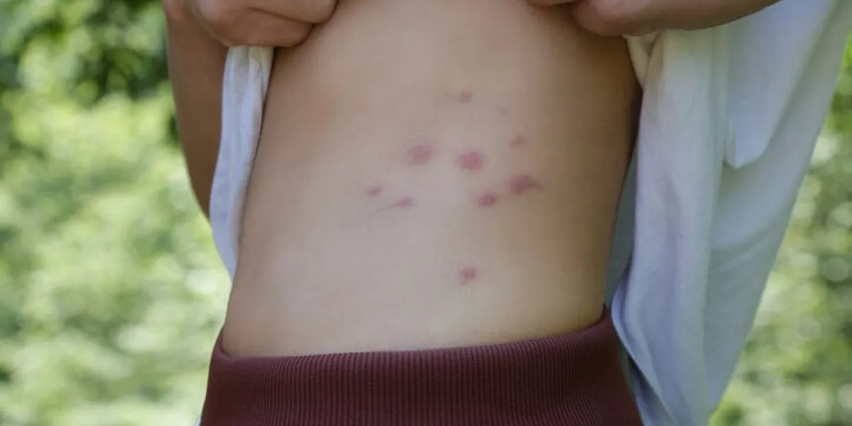 red, swollen and itchy spots on skin caused by insect bites or allergy skin reaction to insect bites