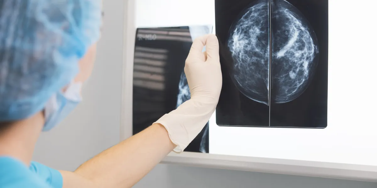 cancer du sein récidive