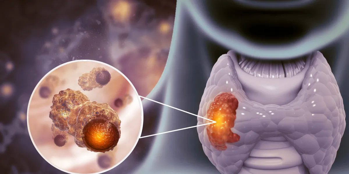 cancer thyroïde
