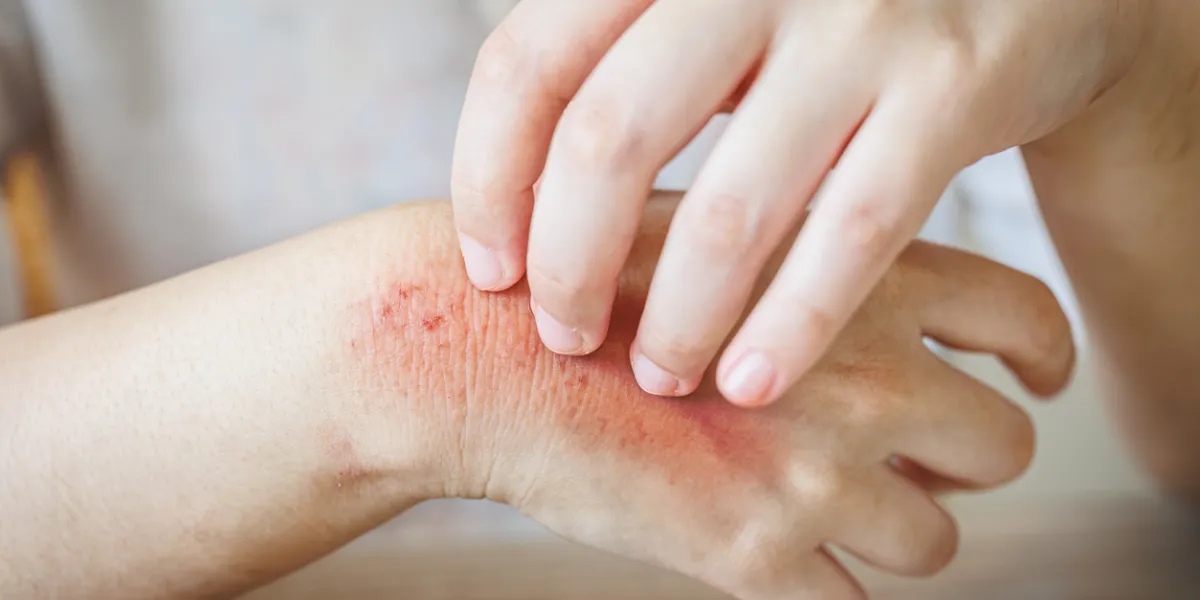 eczéma des mains