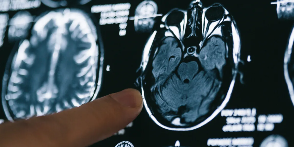 Alzheimer, plan de cerveau