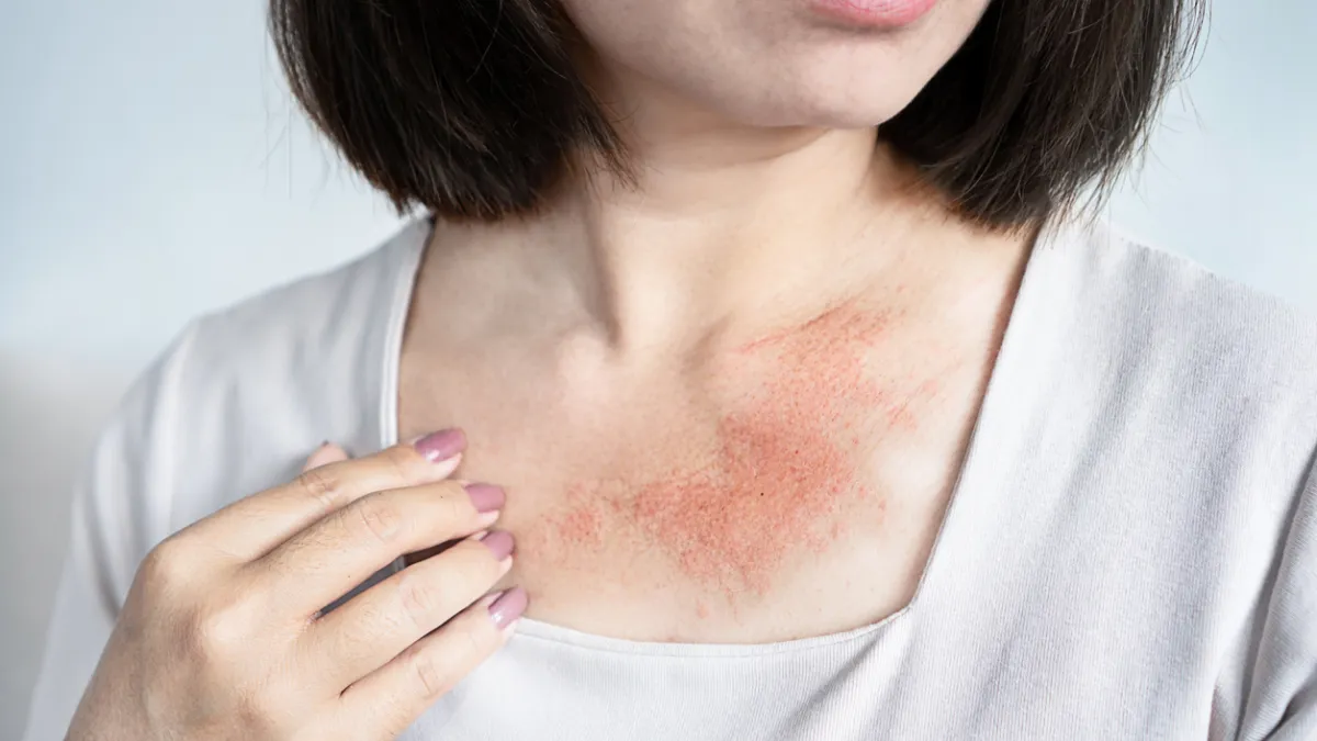 plaques d'eczéma sur le torse en été