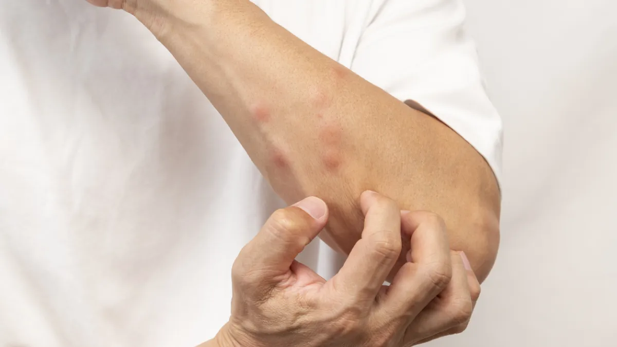 piqûres d'insectes sur le bras d'un homme