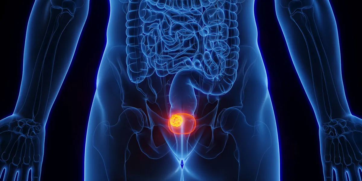 3d rendered medical illustration of male anatomy - bladder cancer plain black background anterior view