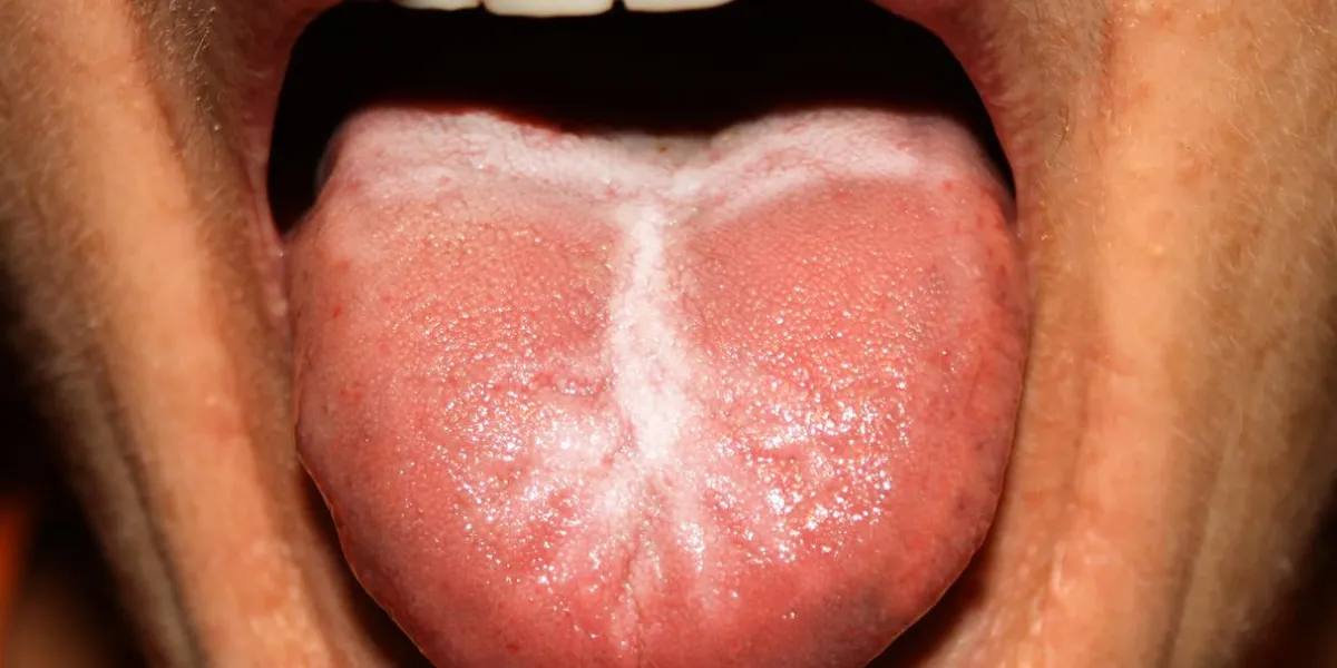 candidiasis in the tongue white coating thrush